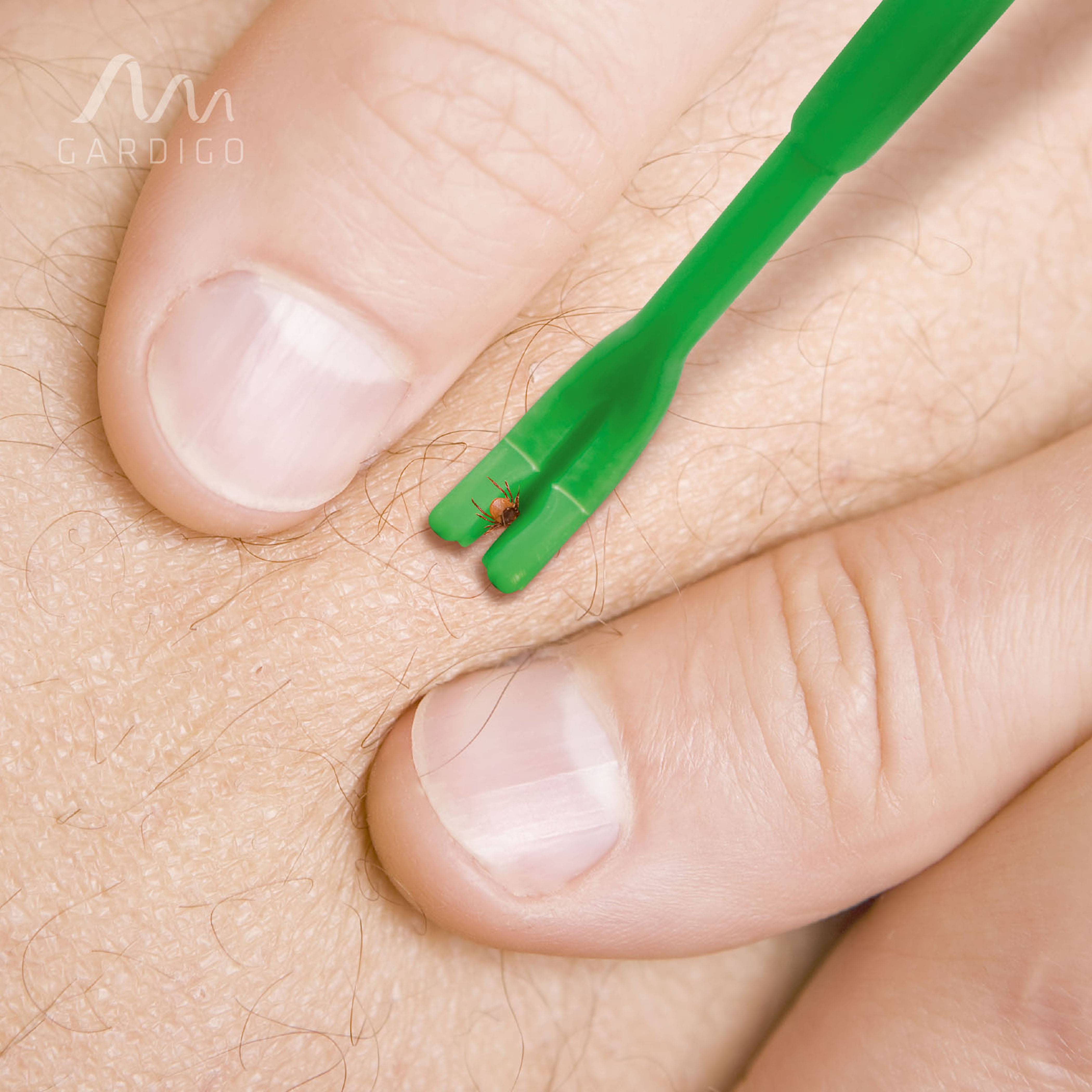 Zecken von der Haut entfernen